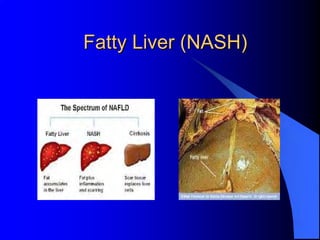 Fatty Liver (NASH)
 