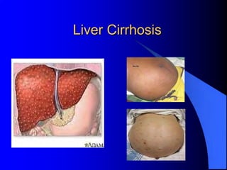 Liver Cirrhosis
 