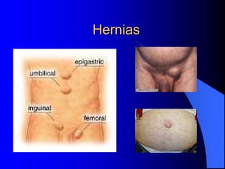 Hernias
 