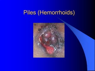 Piles (Hemorrhoids)
 