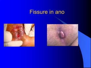 Fissure in ano
 