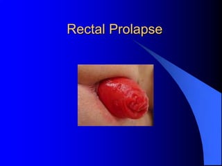 Rectal Prolapse
 