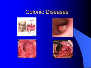 Colonic Diseases
 