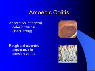 Amoebic Colitis
Appearance of normal
 colonic mucosa
 (inner lining)


Rough and ulcerated
  appearance in
  amoebic colitis
 
