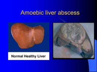 Amoebic liver abscess
 