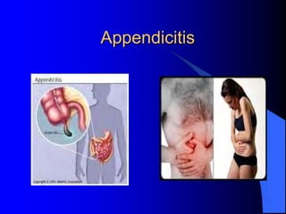 Appendicitis
 