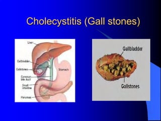 Cholecystitis (Gall stones)
 