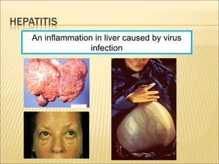 An inflammation in liver caused by virus
infection
 