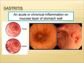 An acute or chronical inflammation on
mucose layer of stomach wall