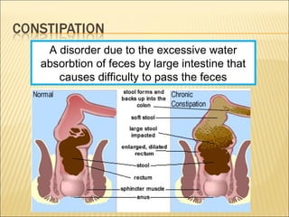 A disorder due to the excessive water
absorbtion of feces by large intestine that
causes difficulty to pass the feces