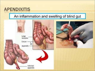 An inflammation and swelling of blind gut