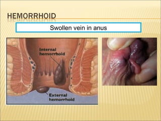 Swollen vein in anus
