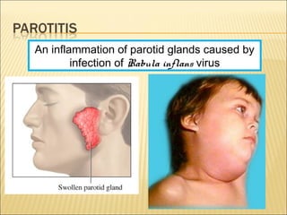 An inflammation of parotid glands caused by
infection of Rabula inflans virus