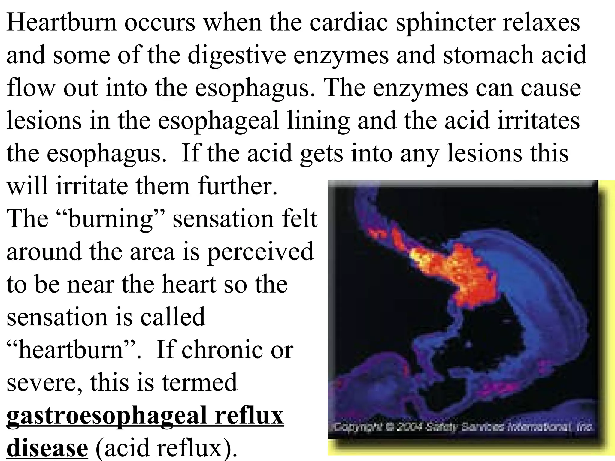 Heartburn occurs when the cardiac sphincter relaxes and some of the digestive enzymes and stomach acid flow out into the esophagus. The enzymes can cause lesions in the esophageal lining and the acid irritates the esophagus.  If the acid gets into any lesions this  will irritate them further.  The “burning” sensation felt around the area is perceived to be near the heart so the sensation is called “heartburn”.  If chronic or severe, this is termed  gastroesophageal reflux disease  (acid reflux). 