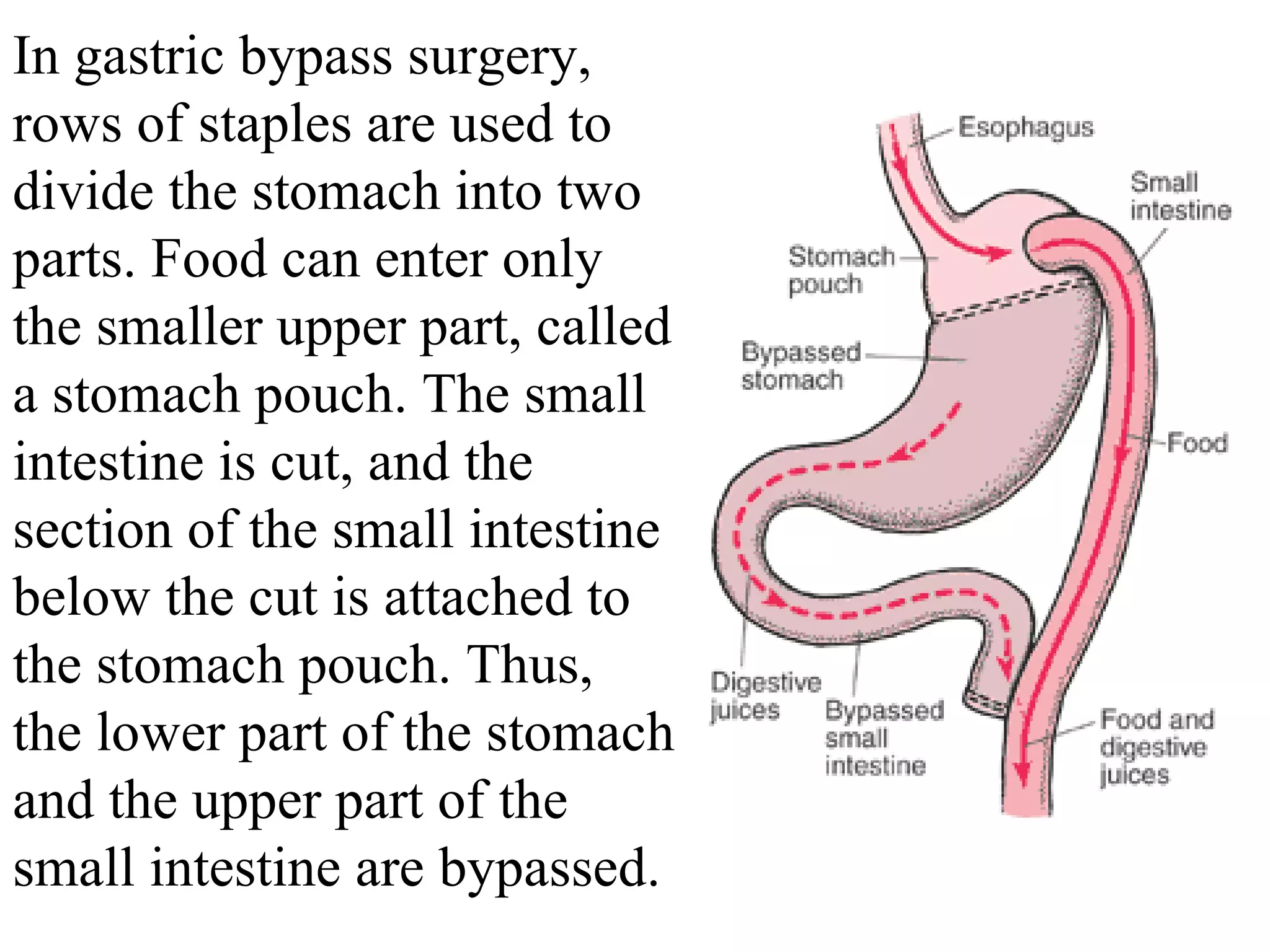 In gastric bypass surgery, rows of staples are used to divide the stomach into two parts. Food can enter only the smaller upper part, called a stomach pouch. The small intestine is cut, and the section of the small intestine below the cut is attached to the stomach pouch. Thus, the lower part of the stomach and the upper part of the small intestine are bypassed. 