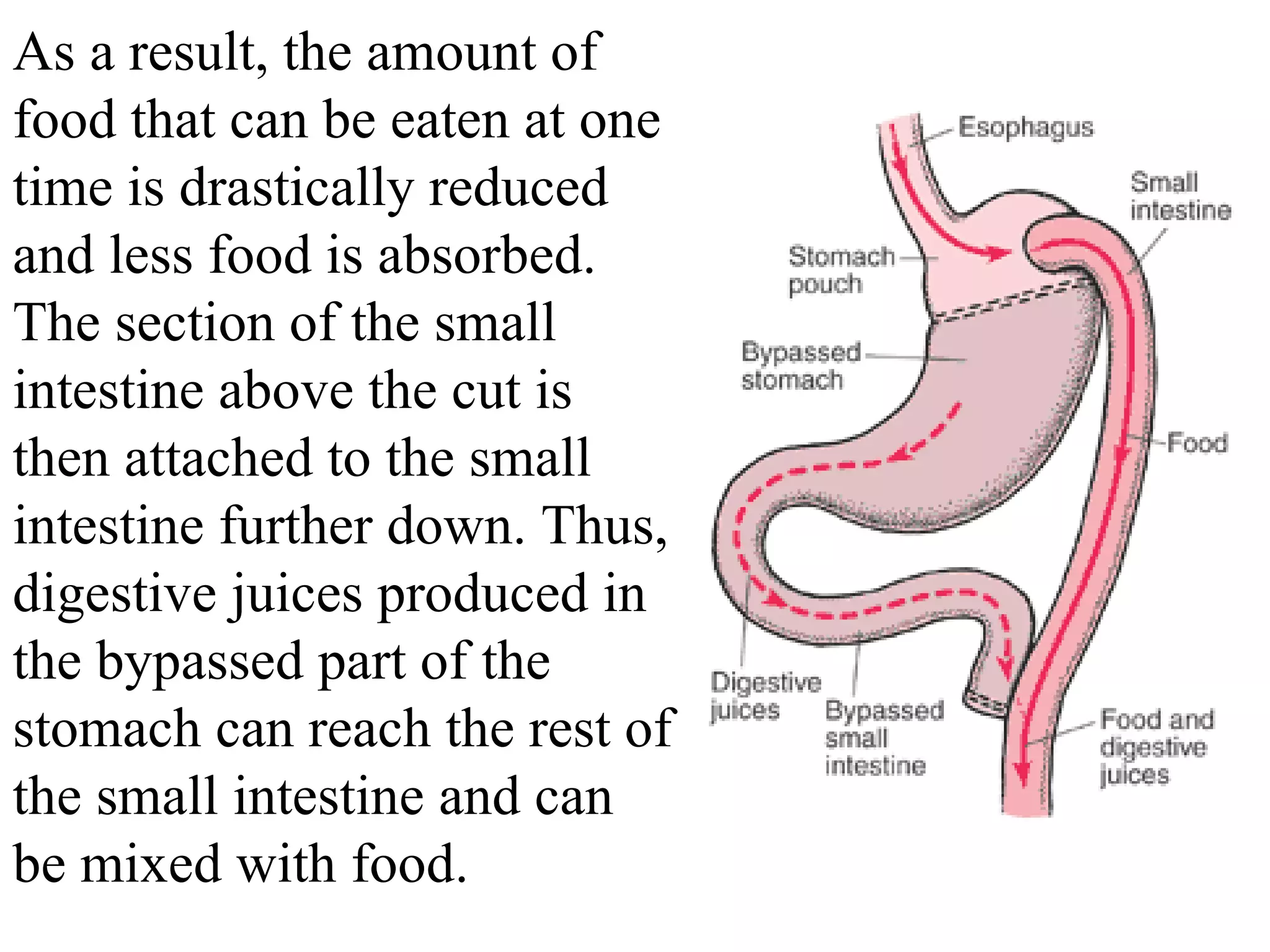 As a result, the amount of food that can be eaten at one time is drastically reduced and less food is absorbed. The section of the small intestine above the cut is then attached to the small intestine further down. Thus, digestive juices produced in the bypassed part of the stomach can reach the rest of the small intestine and can be mixed with food.  