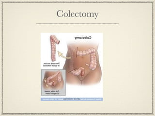 Colectomy
 