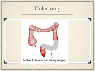 Colectomy
 