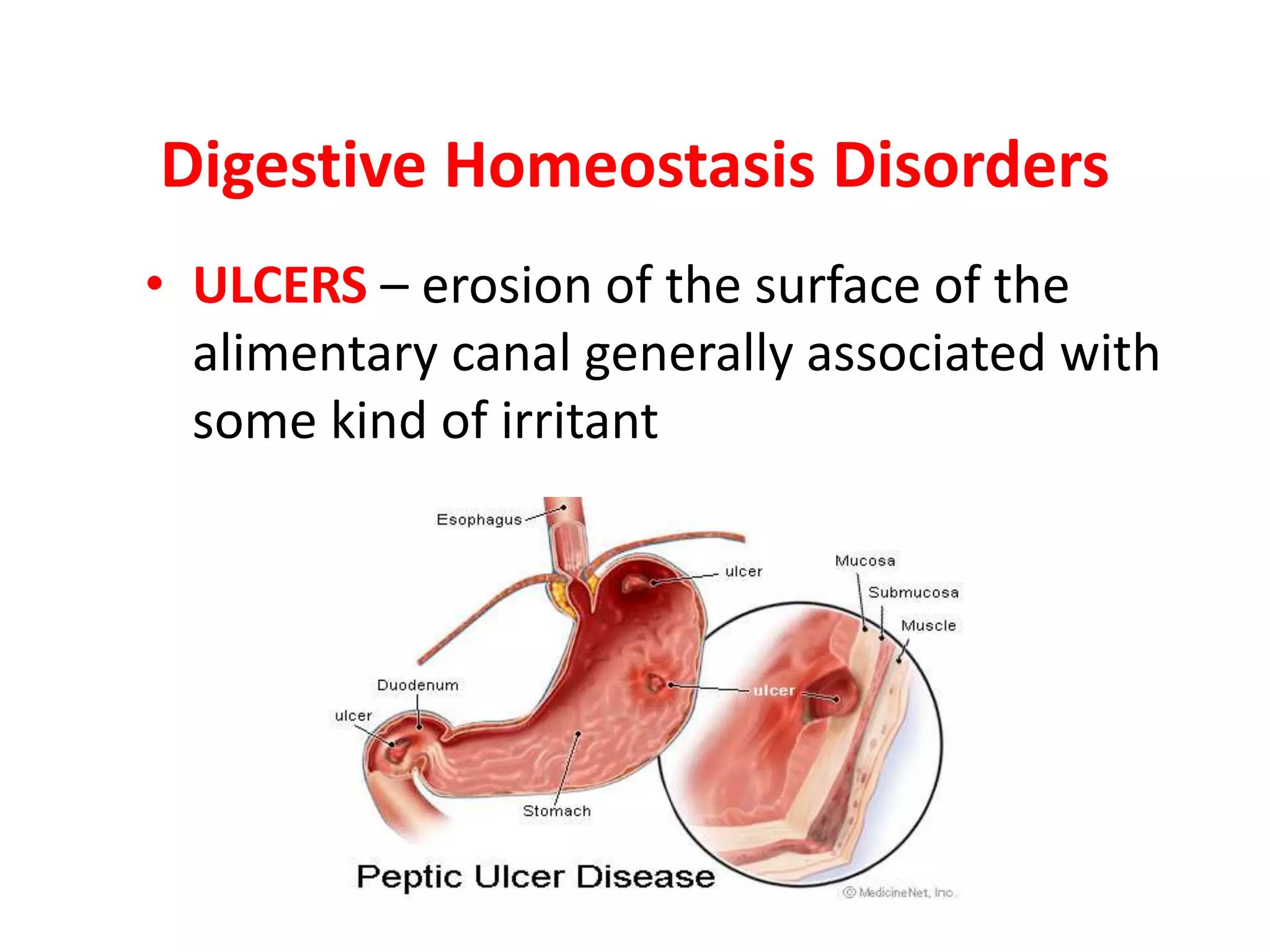 Digestive Homeostasis Disorders
• ULCERS – erosion of the surface of the
alimentary canal generally associated with
some kind of irritant
 