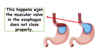 This happens wjen
the muscular valve
in the esophagus
does not close
properly.
 
