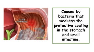 Caused by
bacteria that
weakens the
protective coating
in the stomach
and small
intestine.
 