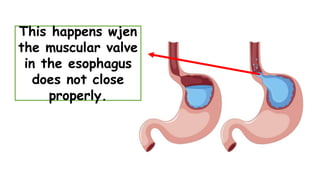 This happens wjen
the muscular valve
in the esophagus
does not close
properly.
 