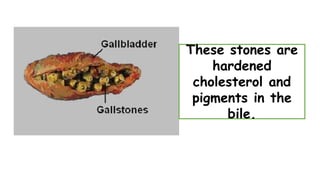 These stones are
hardened
cholesterol and
pigments in the
bile.
 
