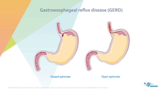 Servier Medical Art de Servier est mis à disposition selon les termes de la licence Creative Commons Attribution 3.0 France
Gastroesophageal reflux disease (GERD)
Closed sphincter Open sphincter
 