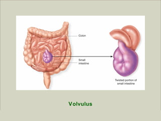 Volvulus
                                                          Copyright ©2009 by Pearson Education, Inc.
Medical Terminology: A Living Language, Fourth Edition        Upper Saddle River, New Jersey 07458
Bonnie F. Fremgen and Suzanne S. Frucht                                           All rights reserved.
 