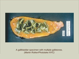 A gallbladder specimen with multiple gallstones.
                        (Martin Rotker/Phototake NYC)
                                                         Copyright ©2009 by Pearson Education, Inc.
Medical Terminology: A Living Language, Fourth Edition       Upper Saddle River, New Jersey 07458
Bonnie F. Fremgen and Suzanne S. Frucht                                          All rights reserved.
 
