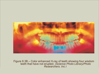 Figure 8.3B – Color enhanced X-ray of teeth showing four wisdom
          teeth that have not erupted. (Science Photo Library/Photo
                              Researchers, Inc.)
                                                         Copyright ©2009 by Pearson Education, Inc.
Medical Terminology: A Living Language, Fourth Edition       Upper Saddle River, New Jersey 07458
Bonnie F. Fremgen and Suzanne S. Frucht                                          All rights reserved.
 
