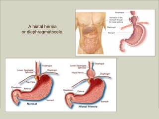 A hiatal hernia
     or diaphragmatocele.




                                                         Copyright ©2009 by Pearson Education, Inc.
Medical Terminology: A Living Language, Fourth Edition       Upper Saddle River, New Jersey 07458
Bonnie F. Fremgen and Suzanne S. Frucht                                          All rights reserved.
 