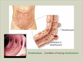 Diverticulosis .. Condition of having diverticulumn.
                                                                 Copyright ©2009 by Pearson Education, Inc.
Medical Terminology: A Living Language, Fourth Edition               Upper Saddle River, New Jersey 07458
Bonnie F. Fremgen and Suzanne S. Frucht                                                  All rights reserved.
 