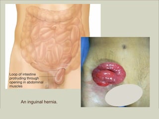 An inguinal hernia.
                                                         Copyright ©2009 by Pearson Education, Inc.
Medical Terminology: A Living Language, Fourth Edition       Upper Saddle River, New Jersey 07458
Bonnie F. Fremgen and Suzanne S. Frucht                                          All rights reserved.
 