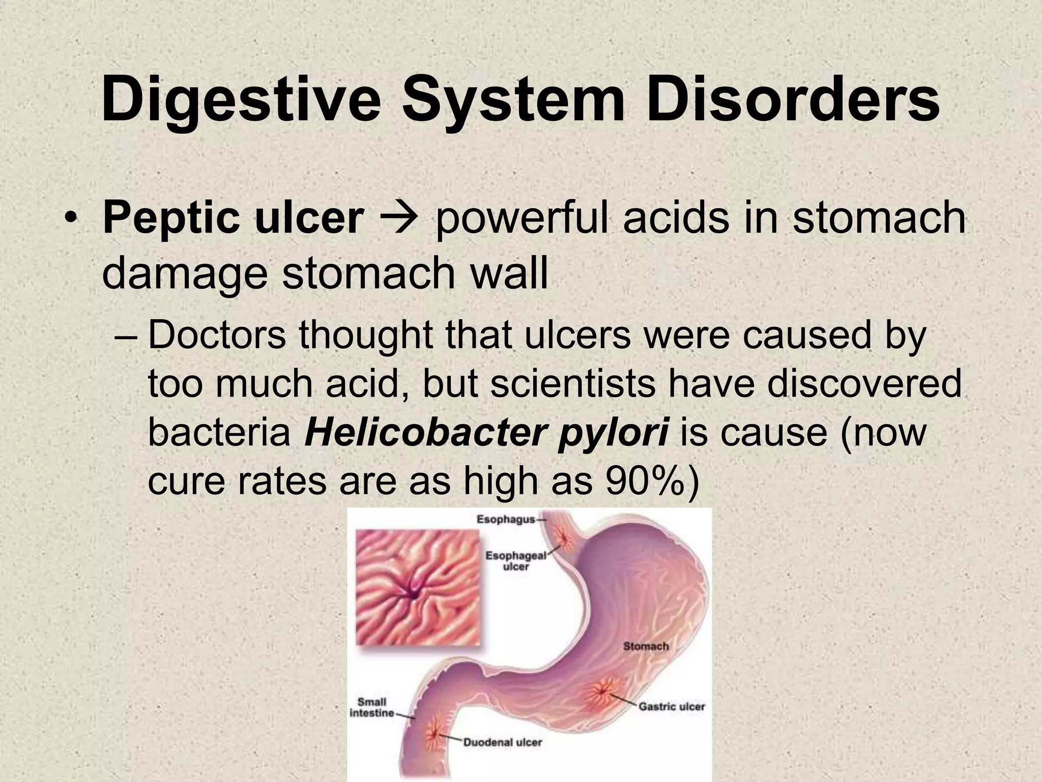 Digestive System Disorders
• Peptic ulcer  powerful acids in stomach
damage stomach wall
– Doctors thought that ulcers were caused by
too much acid, but scientists have discovered
bacteria Helicobacter pylori is cause (now
cure rates are as high as 90%)
 