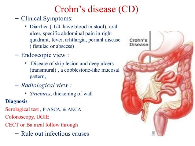 Diagnose Crohn`S Disease - intercloudg9