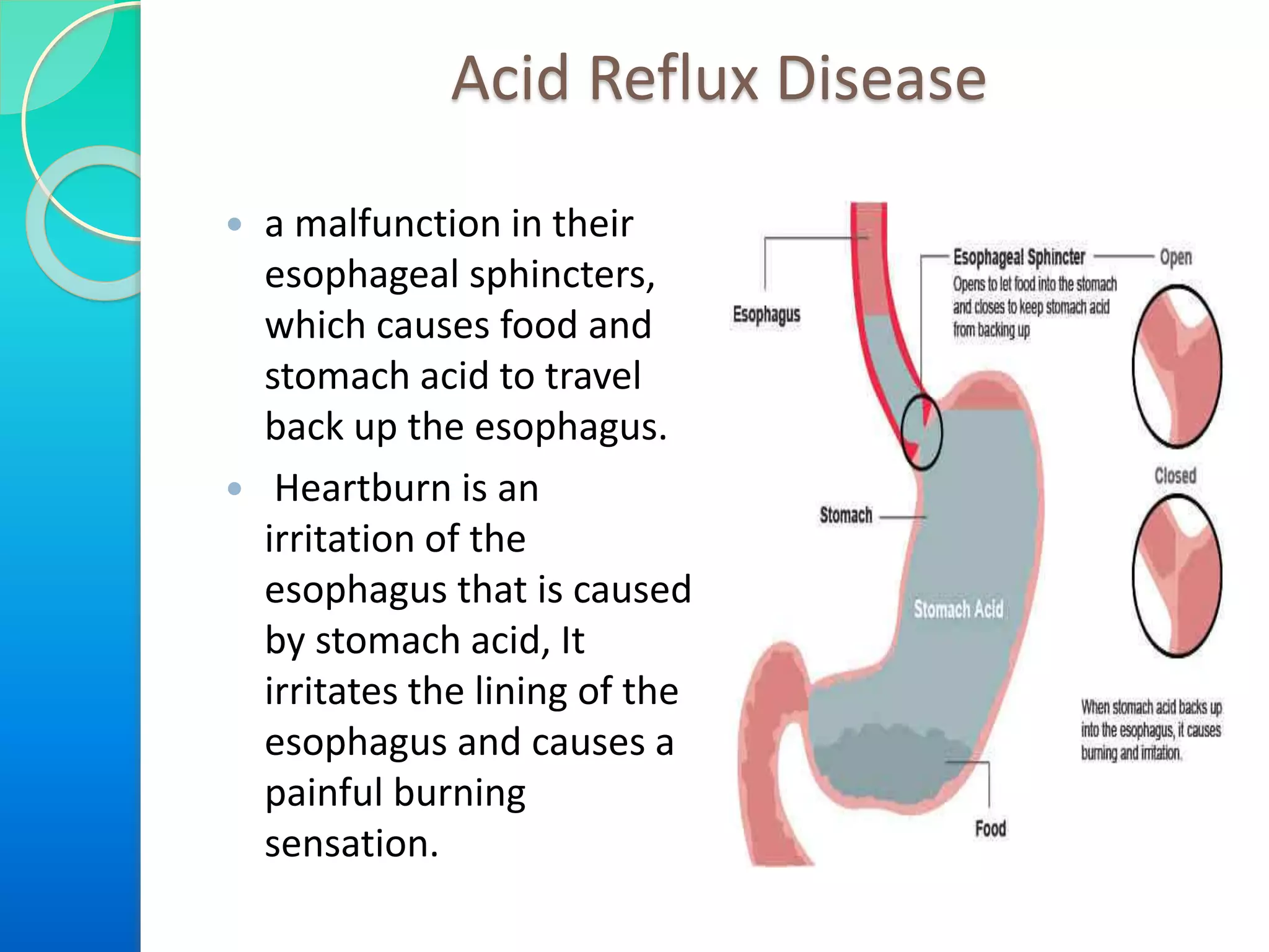 Acid Reflux Disease
 a malfunction in their
esophageal sphincters,
which causes food and
stomach acid to travel
back up the esophagus.
 Heartburn is an
irritation of the
esophagus that is caused
by stomach acid, It
irritates the lining of the
esophagus and causes a
painful burning
sensation.
 