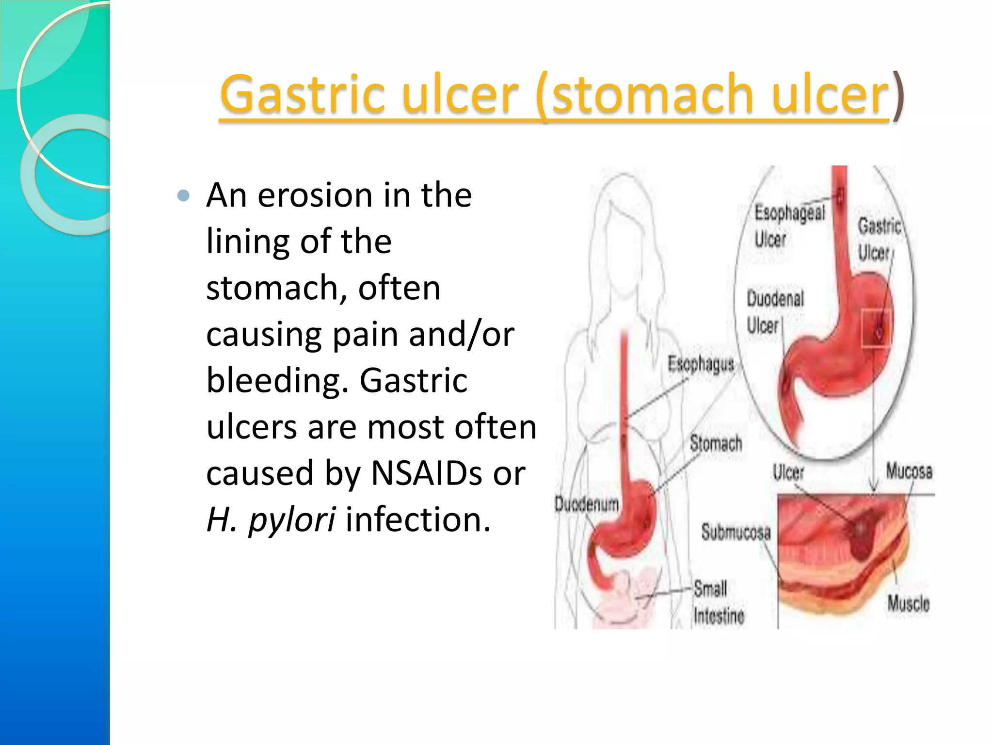 Gastric ulcer (stomach ulcer)
 An erosion in the
lining of the
stomach, often
causing pain and/or
bleeding. Gastric
ulcers are most often
caused by NSAIDs or
H. pylori infection.
 
