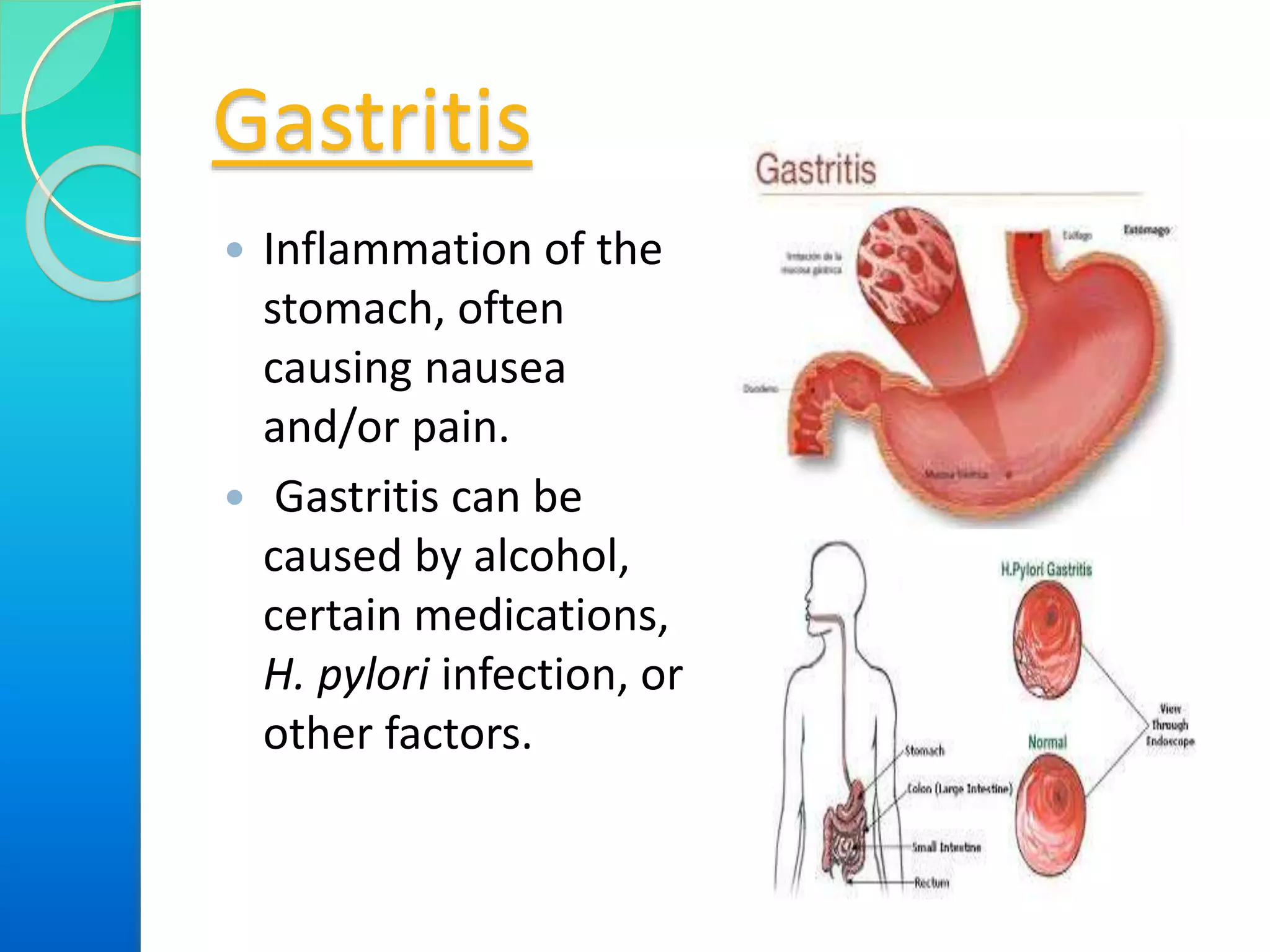 Gastritis
 Inflammation of the
stomach, often
causing nausea
and/or pain.
 Gastritis can be
caused by alcohol,
certain medications,
H. pylori infection, or
other factors.
 