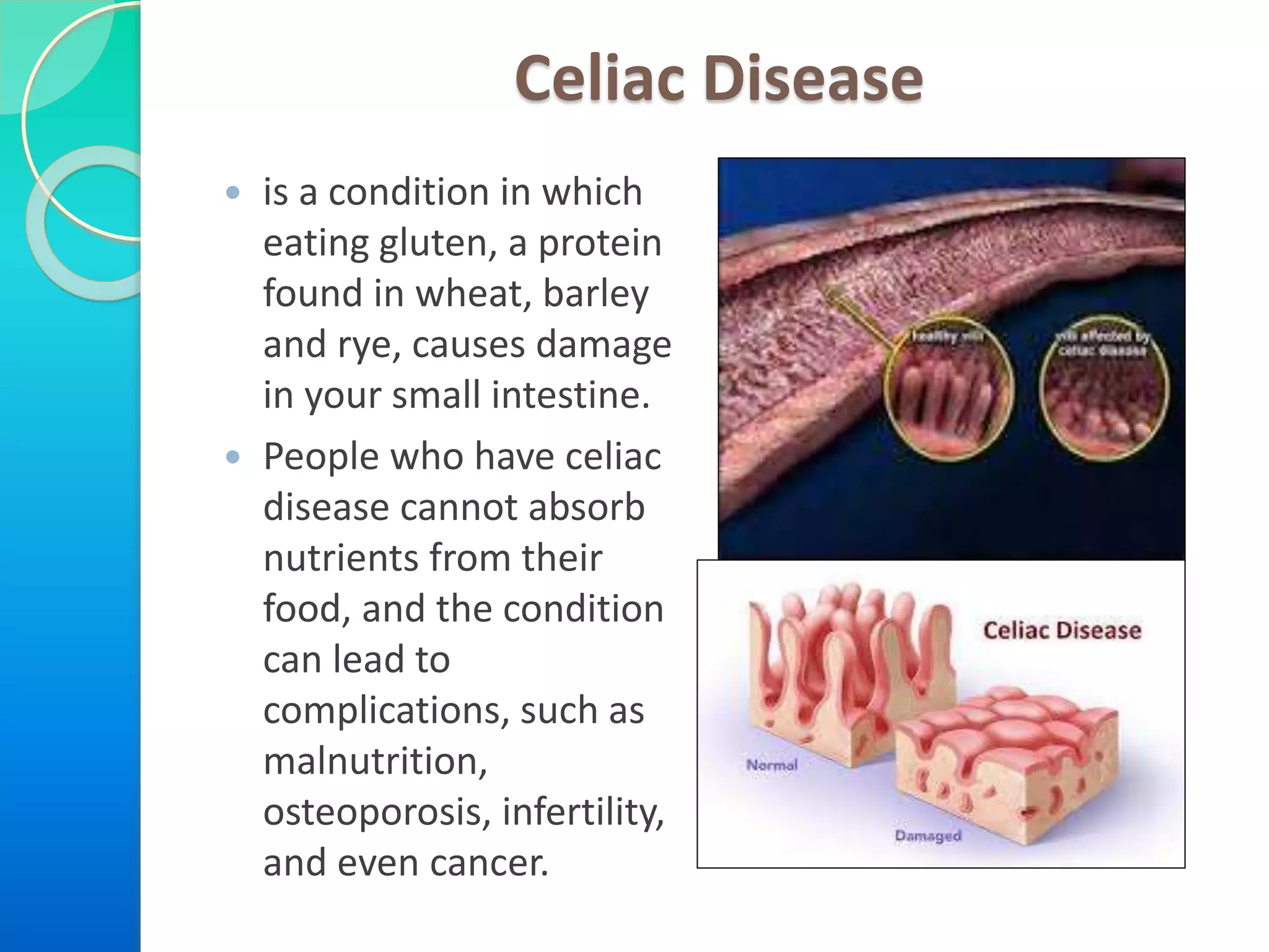 Celiac Disease
 is a condition in which
eating gluten, a protein
found in wheat, barley
and rye, causes damage
in your small intestine.
 People who have celiac
disease cannot absorb
nutrients from their
food, and the condition
can lead to
complications, such as
malnutrition,
osteoporosis, infertility,
and even cancer.
 