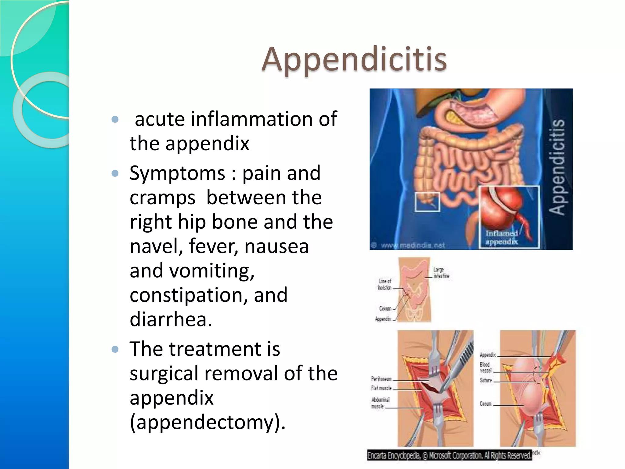Appendicitis
 acute inflammation of
the appendix
 Symptoms : pain and
cramps between the
right hip bone and the
navel, fever, nausea
and vomiting,
constipation, and
diarrhea.
 The treatment is
surgical removal of the
appendix
(appendectomy).

 