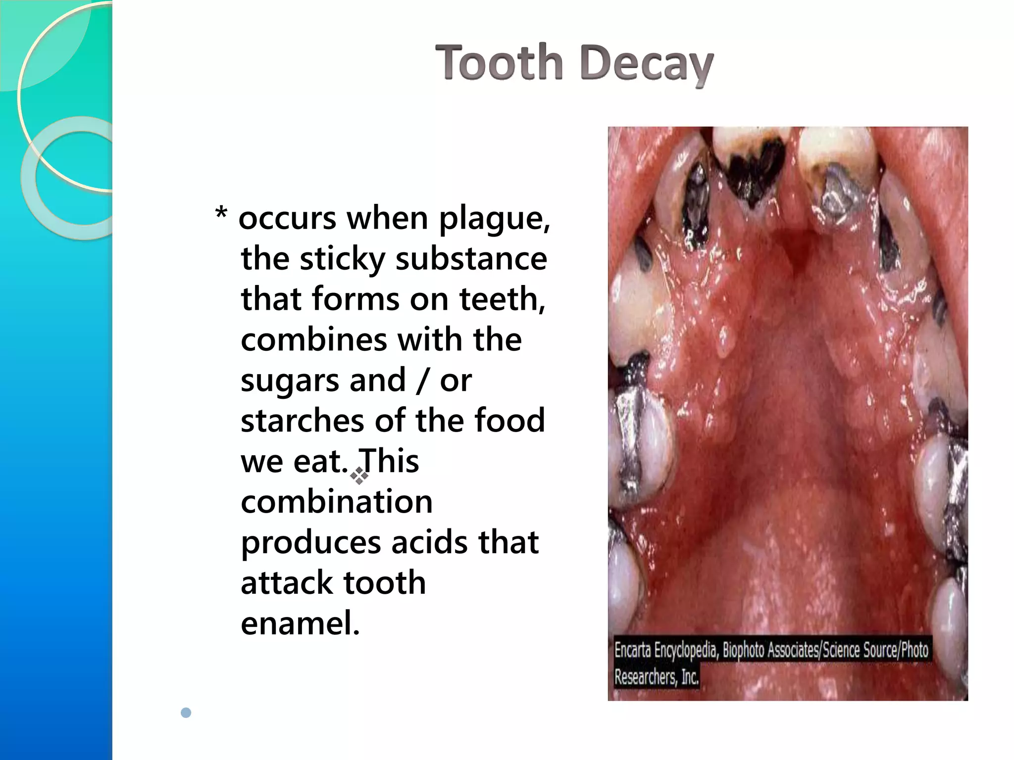 * occurs when plague,
the sticky substance
that forms on teeth,
combines with the
sugars and / or
starches of the food
we eat. This
combination
produces acids that
attack tooth
enamel.

 