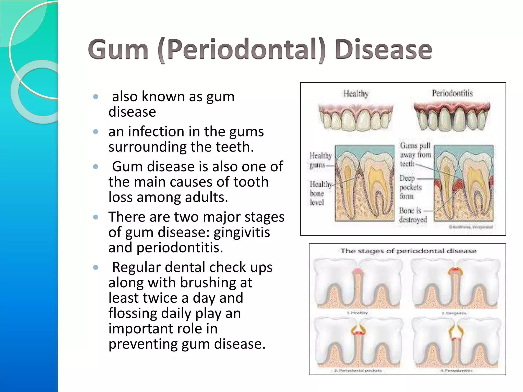  also known as gum
disease
 an infection in the gums
surrounding the teeth.
 Gum disease is also one of
the main causes of tooth
loss among adults.
 There are two major stages
of gum disease: gingivitis
and periodontitis.
 Regular dental check ups
along with brushing at
least twice a day and
flossing daily play an
important role in
preventing gum disease.
 