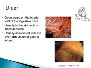  Open sores on the interior
wall of the digestive tract.
 Usually in the stomach or
small intestine.
 Usually associated with the
over-production of gastric
juices.
02/05/18 17:39cottingham
 