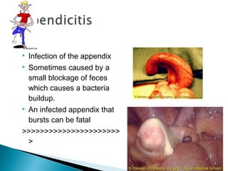  Infection of the appendix
 Sometimes caused by a
small blockage of feces
which causes a bacteria
buildup.
 An infected appendix that
bursts can be fatal
>>>>>>>>>>>>>>>>>>>>>>
>
02/05/18 17:39cottingham
 