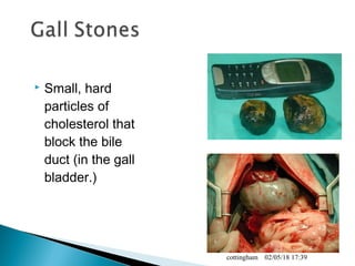  Small, hard
particles of
cholesterol that
block the bile
duct (in the gall
bladder.)
02/05/18 17:39cottingham
 