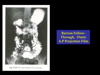 Barium FollowThrough, 15min
A.P Projection Film

 