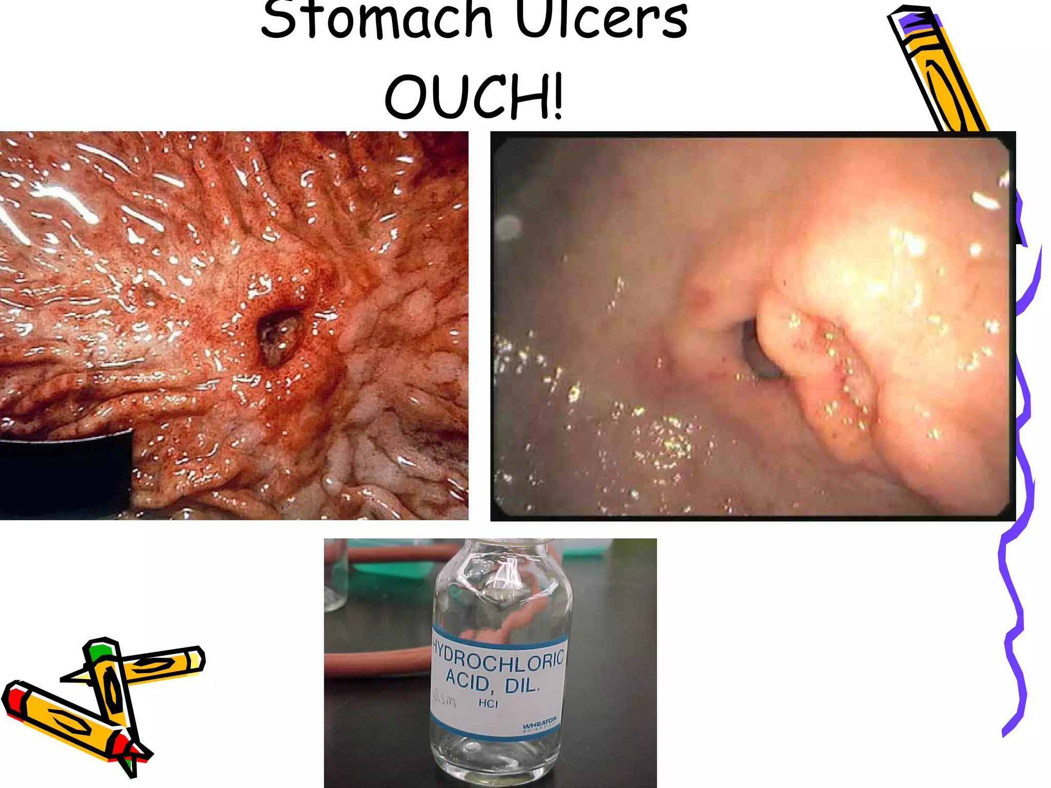 Stomach Ulcers OUCH! 