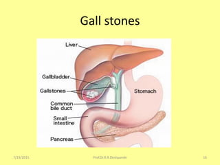 Gall stones
7/19/2015 16Prof.Dr.R.R.Deshpande
 