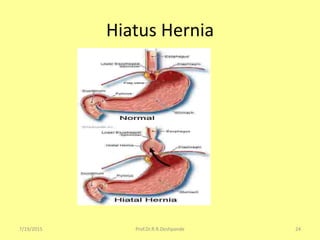 Hiatus Hernia
7/19/2015 24Prof.Dr.R.R.Deshpande
 